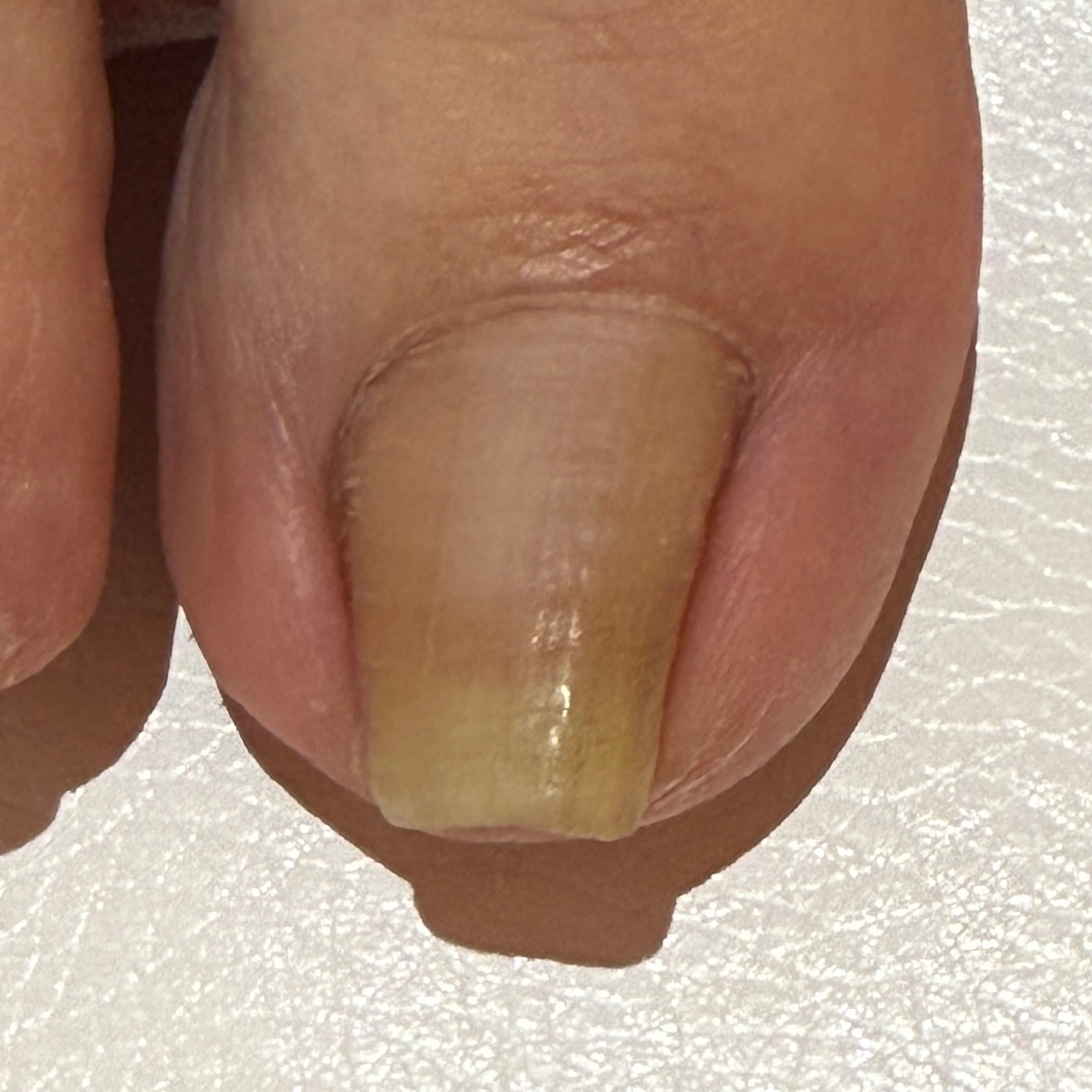 巻き爪3ヶ月ケア Before