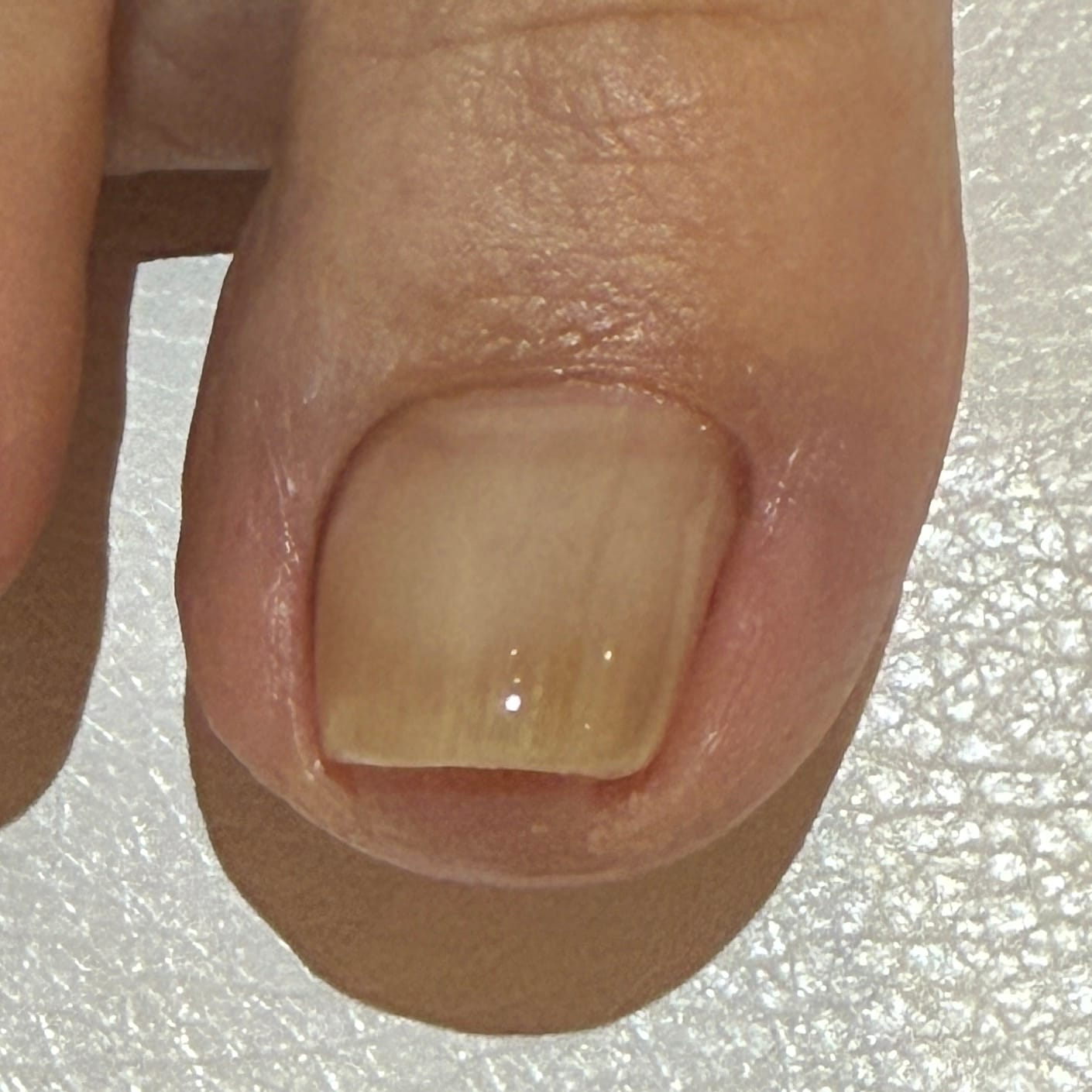 巻き爪3ヶ月ケア After